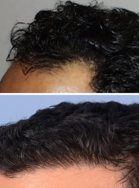 Image of Patient's hairline before and after hair transplant | Shapiro Medical Group | hair transplant mn | Minneapolis, MN