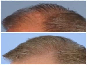 Image of Patient's hairline before and after hair transplant | Shapiro Medical Group | hair restoration surgery | Minneapolis, MN