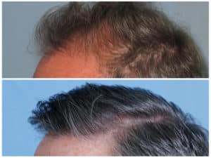 Image of Patient's hairline before and after hair restoration | Shapiro Medical Group | hair transplant mn | Minneapolis, MN
