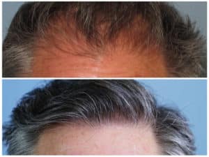 Image of Patient's hairline before and after hair transplant | Shapiro Medical Group | shapiro md | Minneapolis, MN
