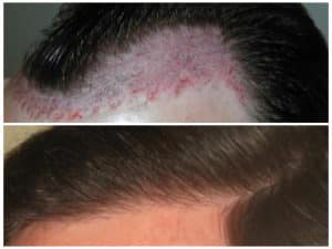 Image of Patient's hairline before and after hair restoration | Shapiro Medical Group | hair transplant usa | Minneapolis, MN
