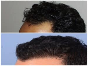 Hairline #2  before and after hair implant | Shapiro Medical Group | crown hair transplant | Minneapolis, MN