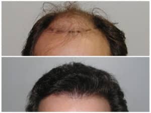 Hairline #3  before and after hair implant | Shapiro Medical Group | hair transplant mn | Minneapolis, MN