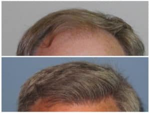 Hairline #4  before and after hair implant | Shapiro Medical Group | hair transplant doctor | Minneapolis, MN