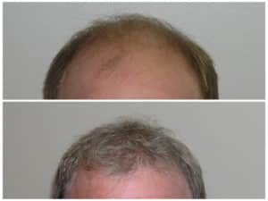 Hairline #6  before and after hair implant | Shapiro Medical Group | hair restoration surgery | Minneapolis, MN