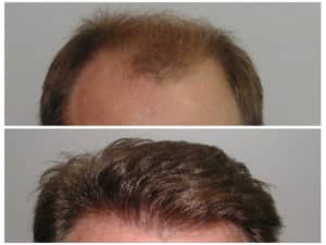 Hairline #7  before and after hair implant | Shapiro Medical Group | hair transplant near me | Minneapolis, MN