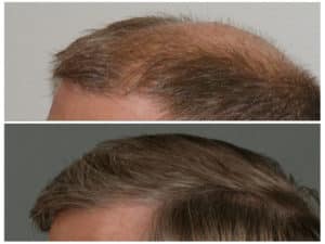 Image of Patient's hairline before and after hair transplant | Shapiro Medical Group | fue procedure | Minneapolis, MN