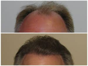 Image of Patient's hairline before and after hair restoration | Shapiro Medical Group | crown hair transplant | Minneapolis, MN