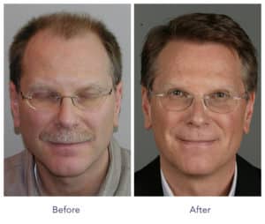 Patient # 20 before and after hair restoration | Shapiro Medical Group | hair transplant usa | Minneapolis, MN