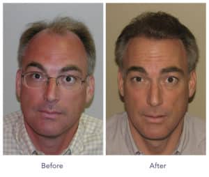 Image of Patient's hairline before and after hair transformation | Shapiro Medical Group | hair restoration surgery | Minneapolis, MN