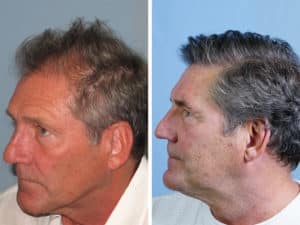 Side view of Patient # 34 before and after hair transplant | Shapiro Medical Group | hair transplant mn | Minneapolis, MN