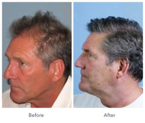 Side view of Patient # 34 before and after hair transplant | Shapiro Medical Group | hair transplant mn | Minneapolis, MN