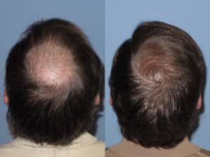 Men's 1 Crown view before and after hair transplant | Shapiro Medical Group | hair restoration surgery  | Minneapolis, MN