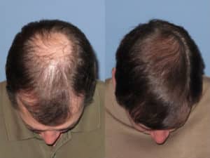 Men's 2 Crown view before and after hair transplant | Shapiro Medical Group | crown hair transplant | Minneapolis, MN