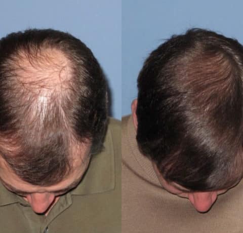 Men's 2 Crown view before and after hair transplant | Shapiro Medical Group | crown hair transplant | Minneapolis, MN