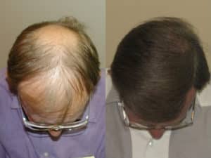 Men's 3 Crown view before and after hair restoration| Shapiro Medical Group | hairline restoration | Minneapolis, MN