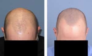 SMP 1 before and after hair transplant | Shapiro Medical Group | micro pigmentation | Minneapolis, MN