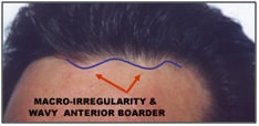 macro-irregularity and a wavy anterior boarder