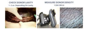 Measure Donor Density | Shapiro Medical Group | Minneapolis, MN