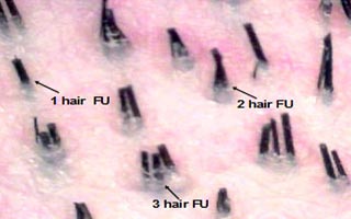 Hair Loss | Hair Transplantation | Shapiro Medical Group