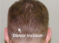 donor strip removed follow angle of hair