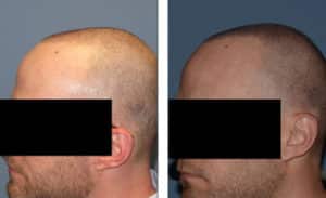 Left view SMP 1 before and after hair transplant | Shapiro Medical Group | fue procedure | Minneapolis, MN