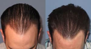 Frontal Image of Patient's hairline before and after hair restoration | Shapiro Medical Group | acell prp | Minneapolis, MN
