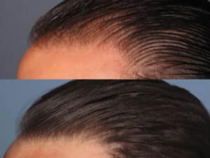 Hairline of SMP 3 before and after hair restoration | Shapiro Medical Group | acell prp | Minneapolis, MN