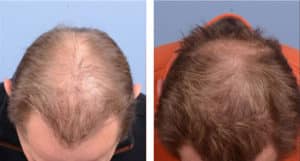 SMP 4 Crown view before and after hair implant | Shapiro Medical Group | follicular unit transplantation | Minneapolis, MN