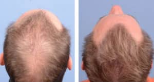 Back Image of Patient's hairline before and after hair transplant | Shapiro Medical Group | follicular unit extraction | Minneapolis, MN
