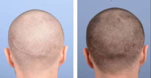 Back Crown Image of Patient's hairline before and after hair restoration | Shapiro Medical Group | micro pigmentation | Minneapolis, MN