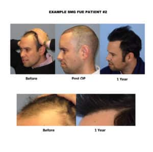 Before and After photos after treatment | Shapiro Medical Group | Minneapolis, MN