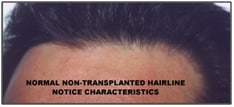 Normal non-transplanted hairline