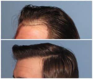 Image of Patient's hairline before and after hair restoration | Shapiro Medical Group | acell prp | Minneapolis, MN