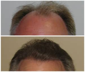 Image of Patient's hairline before and after hair restoration | Shapiro Medical Group | micro pigmentation | Minneapolis, MN