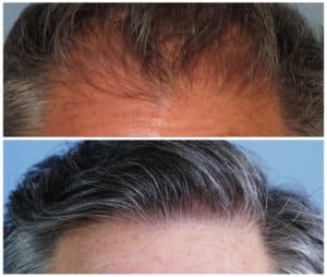 Image of Patient's hairline before and after hair transplant | Shapiro Medical Group | follicular unit transplantation | Minneapolis, MN