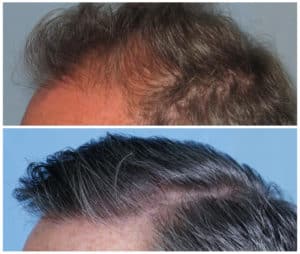 Image of Patient's hairline before and after hair restoration | Shapiro Medical Group | hairline restoration | Minneapolis, MN