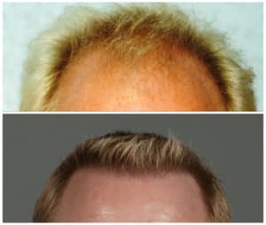Frontal view of Men 11 Crown Before and After Hair Transplant | Shapiro Medical Group | Hair Transplant MN | Minneapolis, MN
