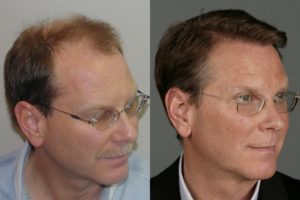 Right sideview of Patient # 20 before and after hair implant | Shapiro Medical Group | best hair transplant | Minneapolis, MN