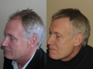 Left sideview of Patient # 1 hairline before and after hair restoration | Shapiro Medical Group | hair transplant usa | Minneapolis, MN
