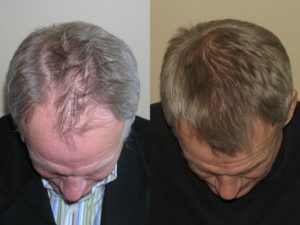Crown view of Patient # 1 hairline before and after hair restoration | Shapiro Medical Group | hair transplant usa | Minneapolis, MN