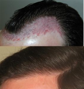 Image of Patient's hairline before and after hair restoration | Shapiro Medical Group | follicular unit transplantation | Minneapolis, MN