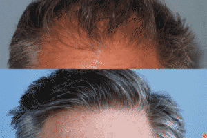 Image of Patient's hairline before and after hair restoration | Shapiro Medical Group | hair transplant mn | Minneapolis, MN