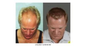 Crown view of Men 11 in Men's Gallery Before and After Hair Transplant | Shapiro Medical Group | Hair Transplant MN | Minneapolis, MN