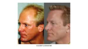 Left sideview of Men 11 in Men's Gallery Before and After Hair Transplant | Shapiro Medical Group | Hair Transplant MN | Minneapolis, MN