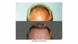 Crown of Men 11 Before and After Hair Transplant | Shapiro Medical Group | Hair Transplant MN | Minneapolis, MN