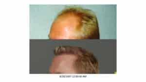 Crown Left sideview of Men 11 Before and After Hair Transplant | Shapiro Medical Group | Hair Transplant MN | Minneapolis, MN