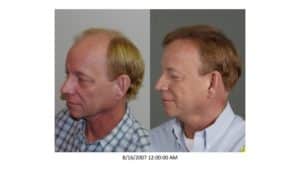 Left sideview of Patient # 32 before and after hair implant | Shapiro Medical Group | hairline restoration | Minneapolis, MN