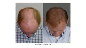 Frontal view of Patient # 32 before and after hair implant | Shapiro Medical Group | hairline restoration | Minneapolis, MN