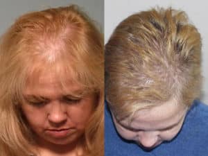 Frontal view of Women's 3 hair before and after hair restoration | Shapiro Medical Group | micro pigmentation | Minneapolis, MN